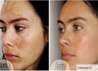 Hyperpigmentation de la peau, causes et remèdes